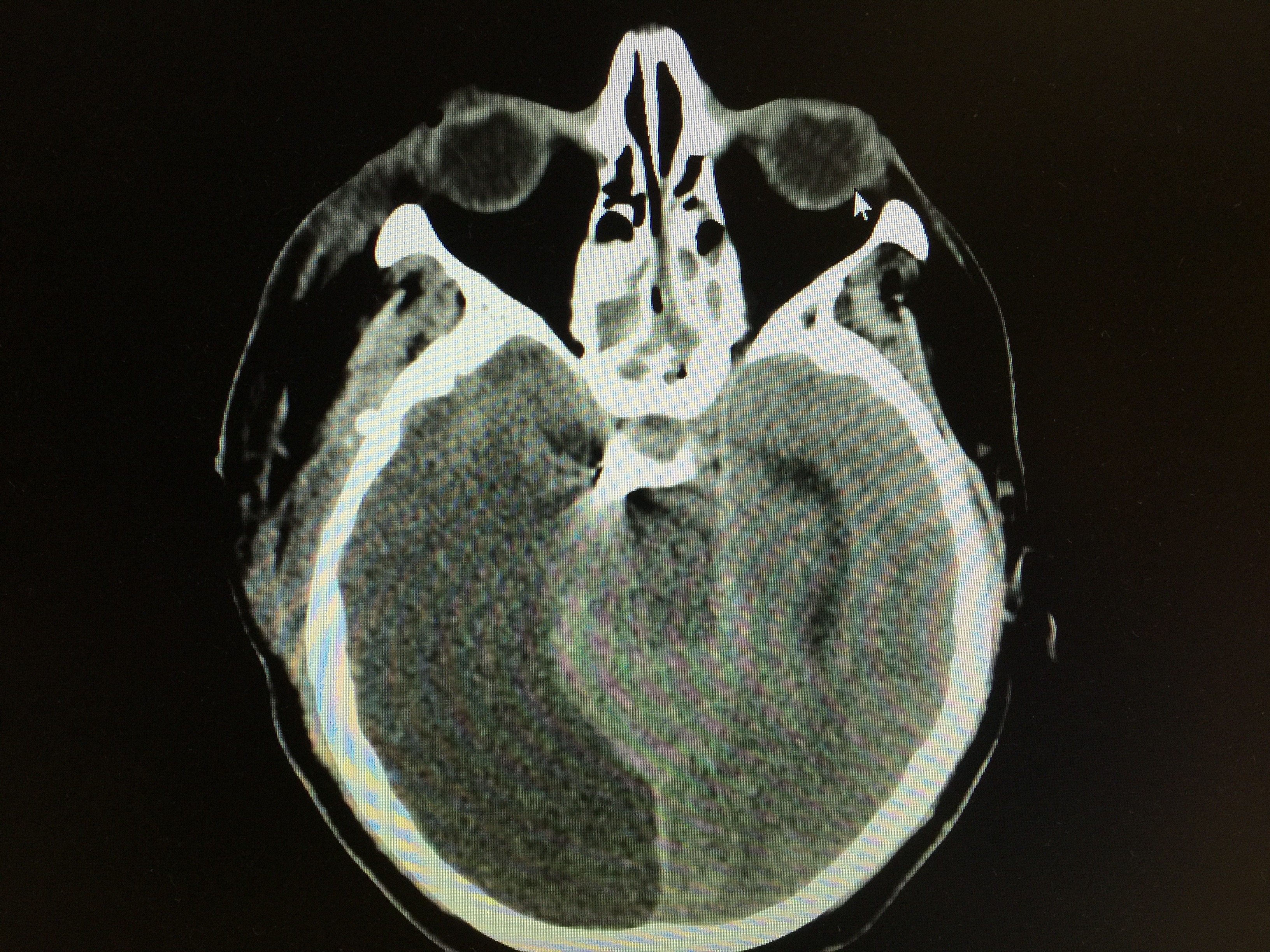 ischemia cerebrale emisferica